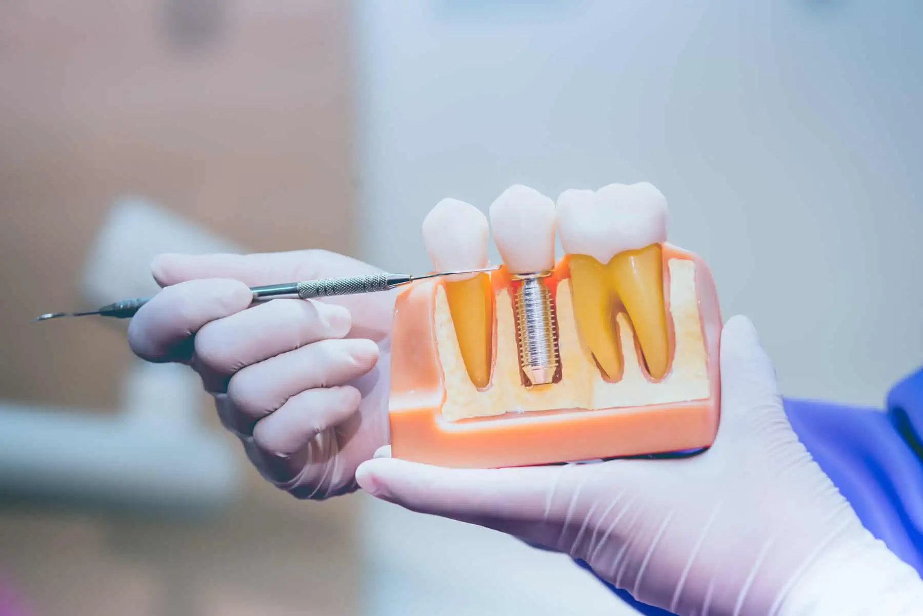 Dental implants placed to anchor a full arch restoration