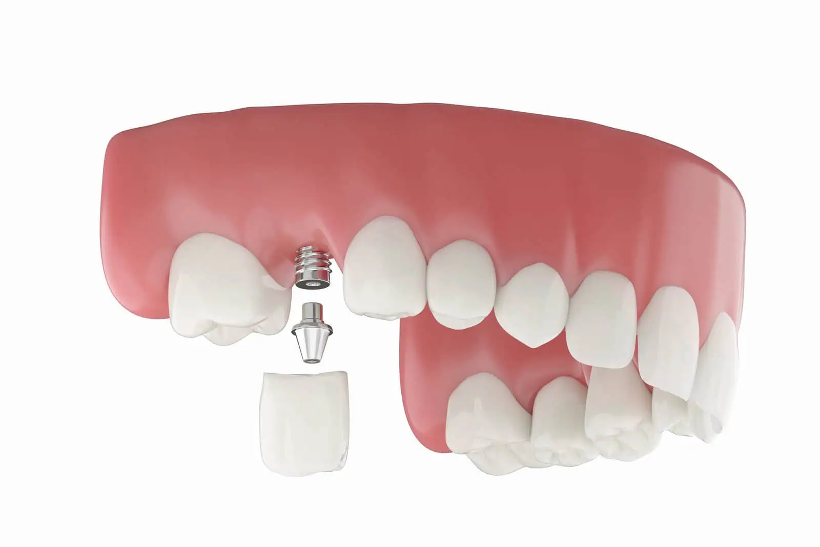 Single dental implant used to replace a tooth after extraction