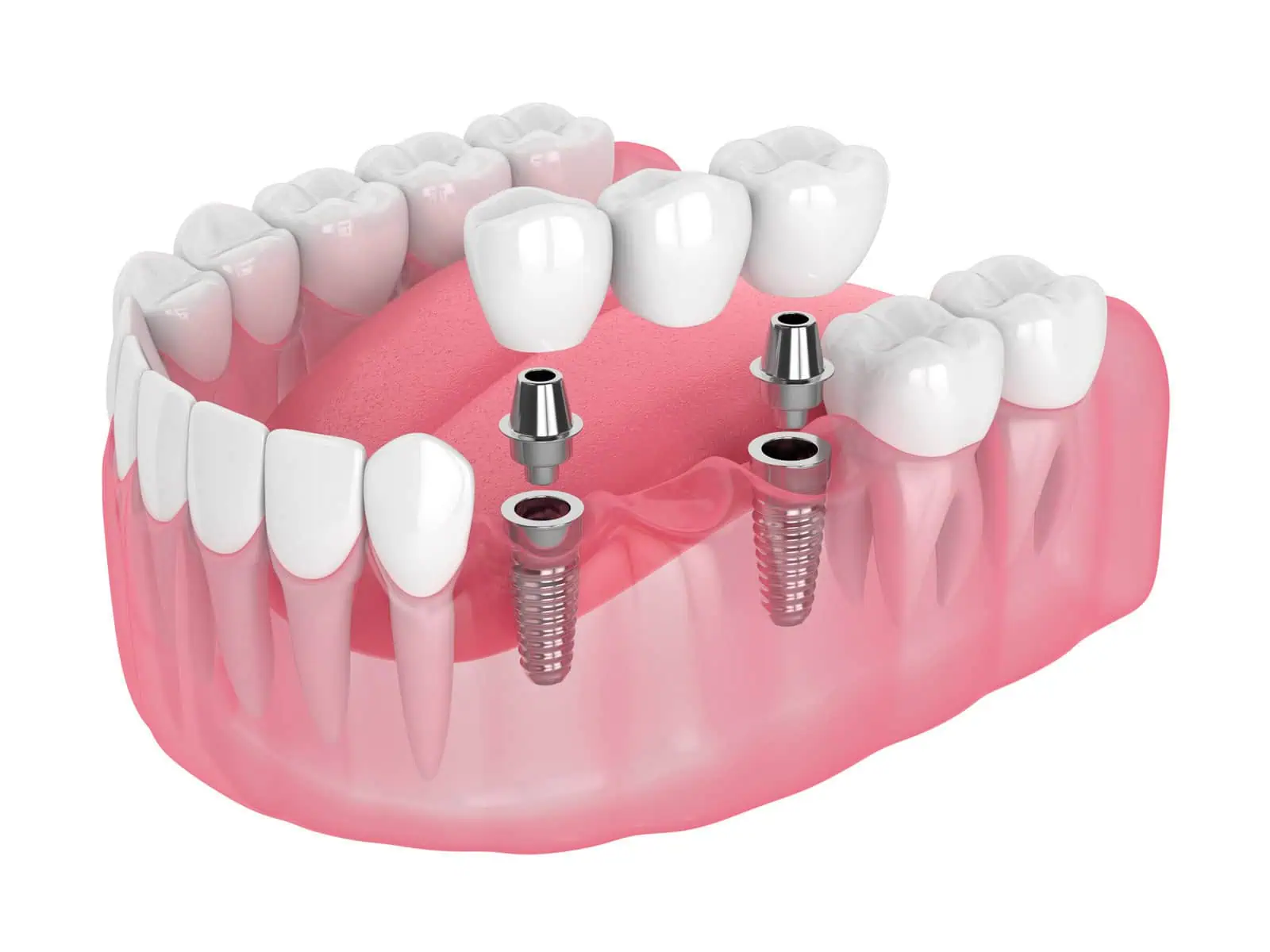 Implant-supported dentures providing a secure, stable fit